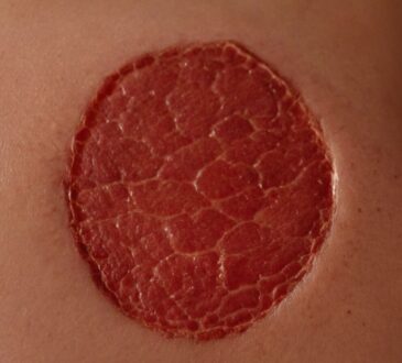 Rote Flecken am Körper, die nicht jucken: Ursachen und Behandlungsmöglichkeiten