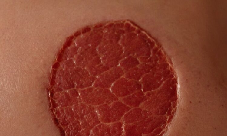 Rote Flecken am Körper, die nicht jucken: Ursachen und Behandlungsmöglichkeiten